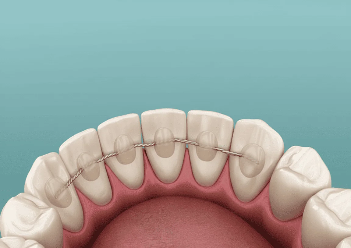 Отклеился ретейнер: что делать, насколько это опасно?